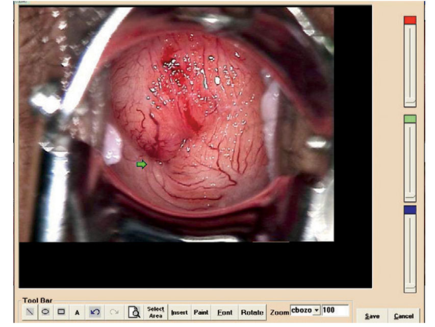 COLPOSCOPY SOFTWARE for 29620, 29600 with 29603