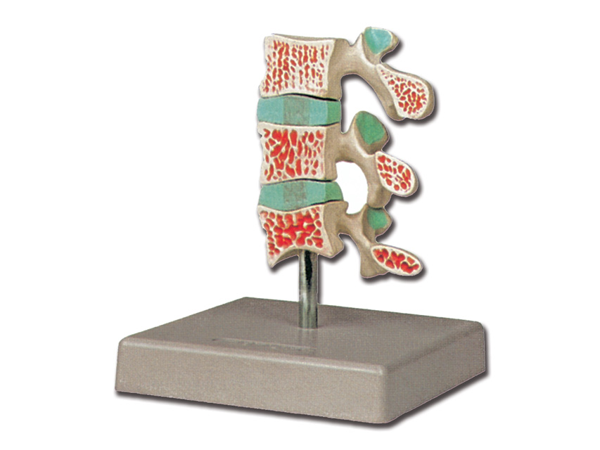 ADVANCED OSTEOPOROSIS