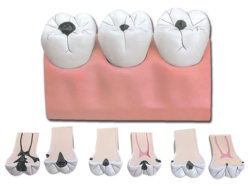 [40211] CARIES DENTAIRES - 7 pièces - 4X